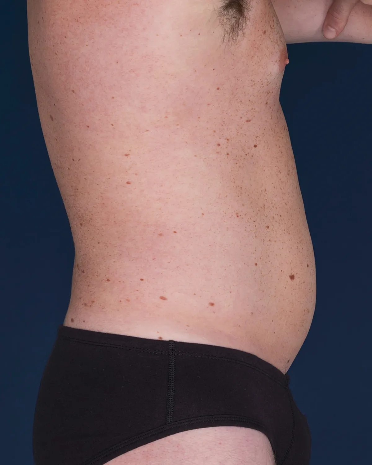 Coolsculpting Before & After