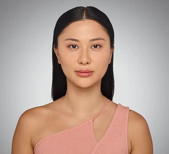 Juvederm Before & After