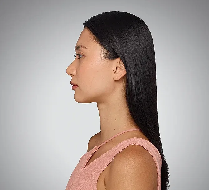 Juvederm Before & After